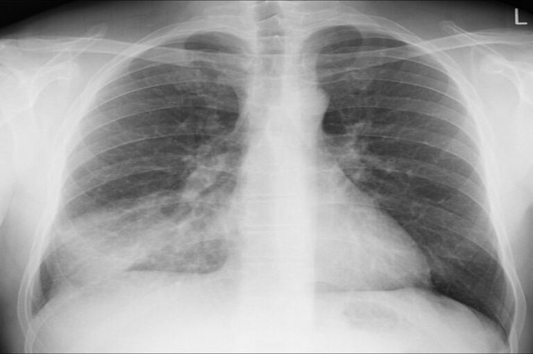 Pneumonia diseases: बच्चों में तेजी से फैल रहा है निमोनिया, ये जरा सी चूक हो सकती है जानलेवा,जानें