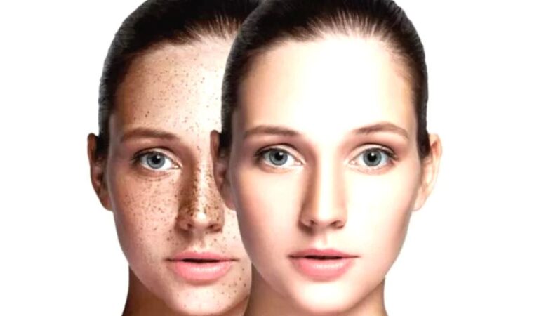 Pigmentation: प्रेग्नेंसी के बाद आ गई हैं झाइयां, तो ये फूड्स लाएंगे खोई चमक,जानें कैसे