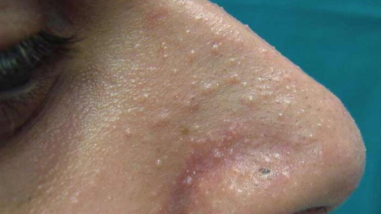 Whiteheads : व्हाइटहेड्स की समस्या हैं परेशान, तो जानें इससे छुटकारा पाने के उपाय , पढ़ें