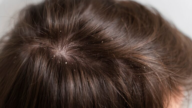Home Remedies for Dandruff: सिर्फ 10 मिनट में डैंड्रफ से छुटकारा दिलाएंगे ये दमदार घरेलू नुस्खे ,जरूर आजमाएं