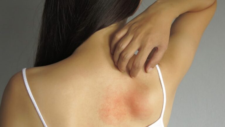 Summer Tips: गर्मियों में घमौरियों का काल है ये घरेलू नुस्खा, उपयोग के कुछ देर बाद ही मिलेगी राहत