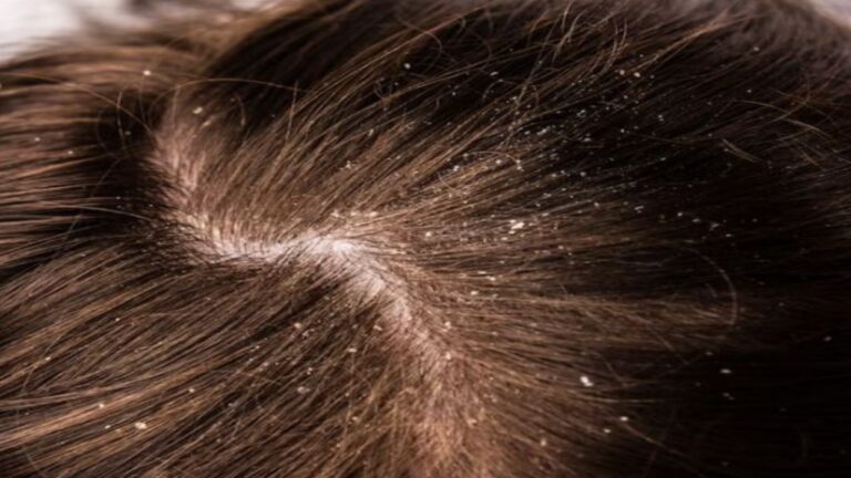 Dandruff Problem:डैंड्रफ से बालों का हाल हो गया है बेहाल,तो इस उपाय से इसे करें हमेशा के लिए बाय-बाय