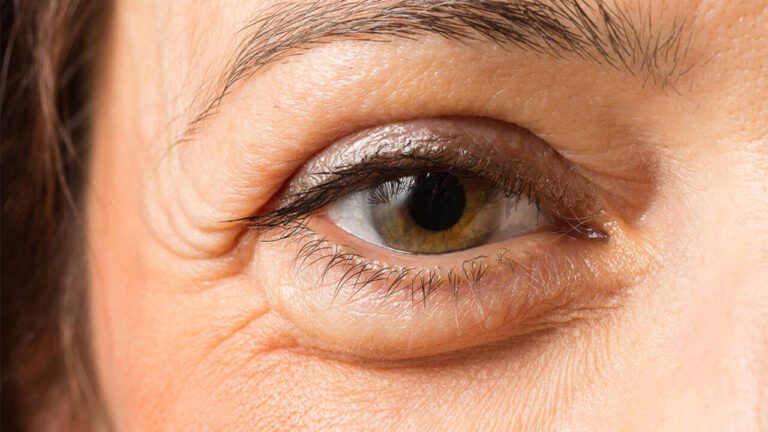 Eye Swelling: आखों में होने वाली सूजन को ना करें इग्नोर, हो सकती है ये भयंकर बीमारी
