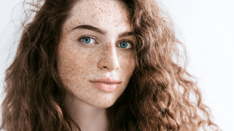 Freckles Remove : चेहरे की खूबसूरती में खलल डाल रही हैं ये झाइयां, फॉलो करें ये आसान टिप्स, जल्दी मिलेगी निजात