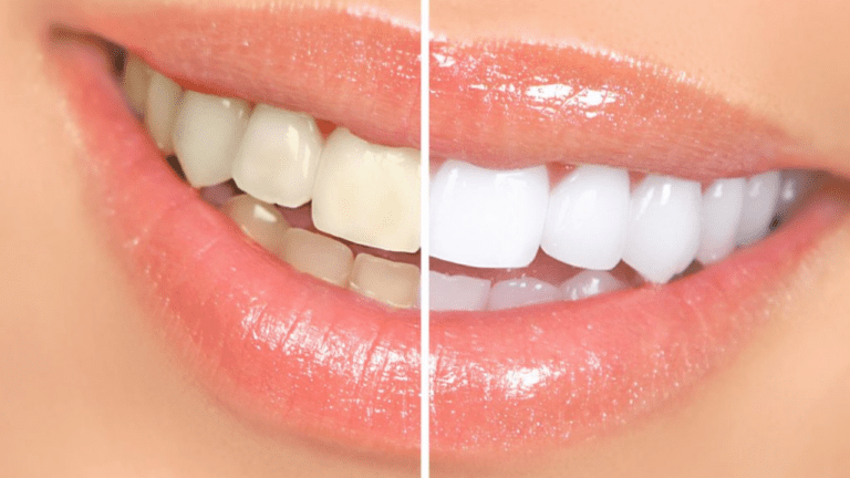 Teeth whitening Tips : दांत पर जमने लगी है पीली परत तो ये घरेलू नुस्खे, चांदी जैसा चमक जायेगा टीथ