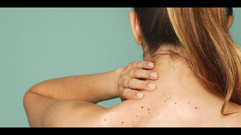 गर्दन पर बने काले धब्बे इन बड़ी बीमारियों के हैं लक्षण, जानें बचाव के उपाय