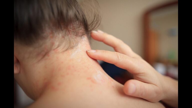 घमौरी की समस्या से हैं परेशान तो ट्राई करें ये घरेलू उपाय, कुछ ही दिनों में दिखेगा चमत्कारिक रिजल्ट