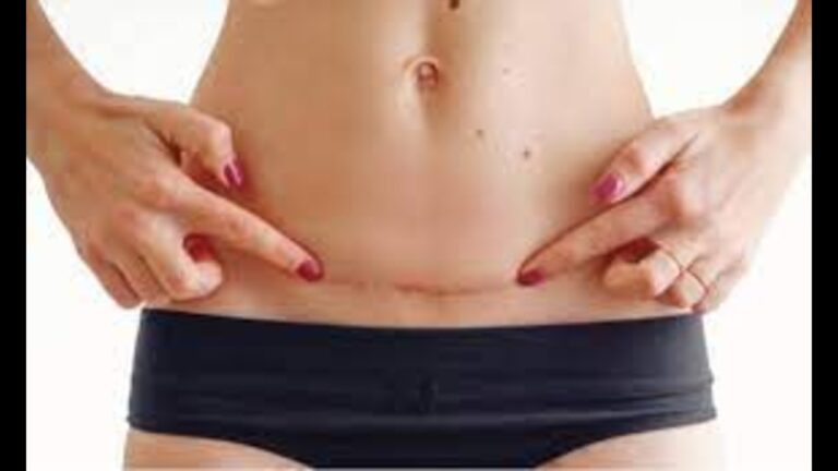 Cesarean Pain: सिजेरियन के बाद दर्द से पाना चाहते हैं छुटकारा,तो डाइट में शामिल करें ये चीजें