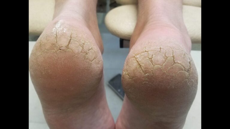 सर्दी में फट जाती हैं आपकी एड़ियां,तो अपनाएं ये घरेलू उपाय,चंद दिनों में दिखेगा असर