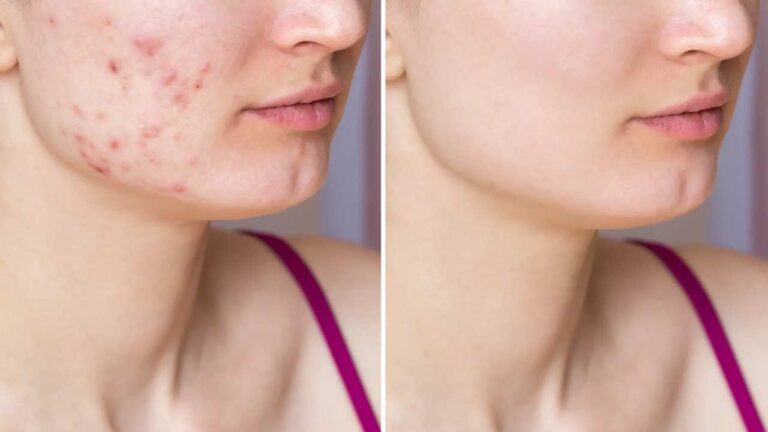 Pimples से छुटकारा के लिए चेहरे पर ट्राई करें ये आयुर्वेदिक उपाय, दिखेगा चमत्कारीक फायदा